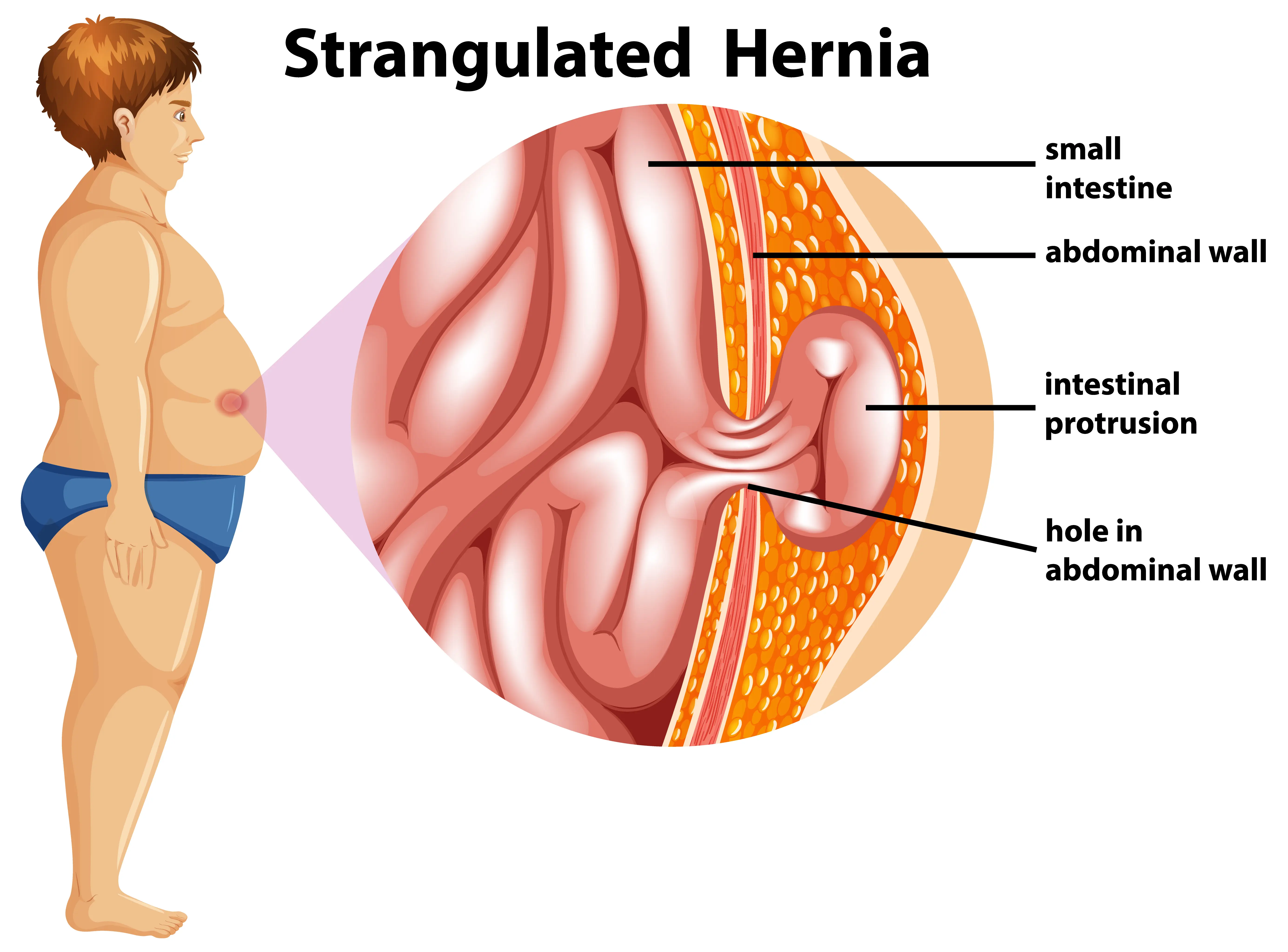 Hernia Surgery