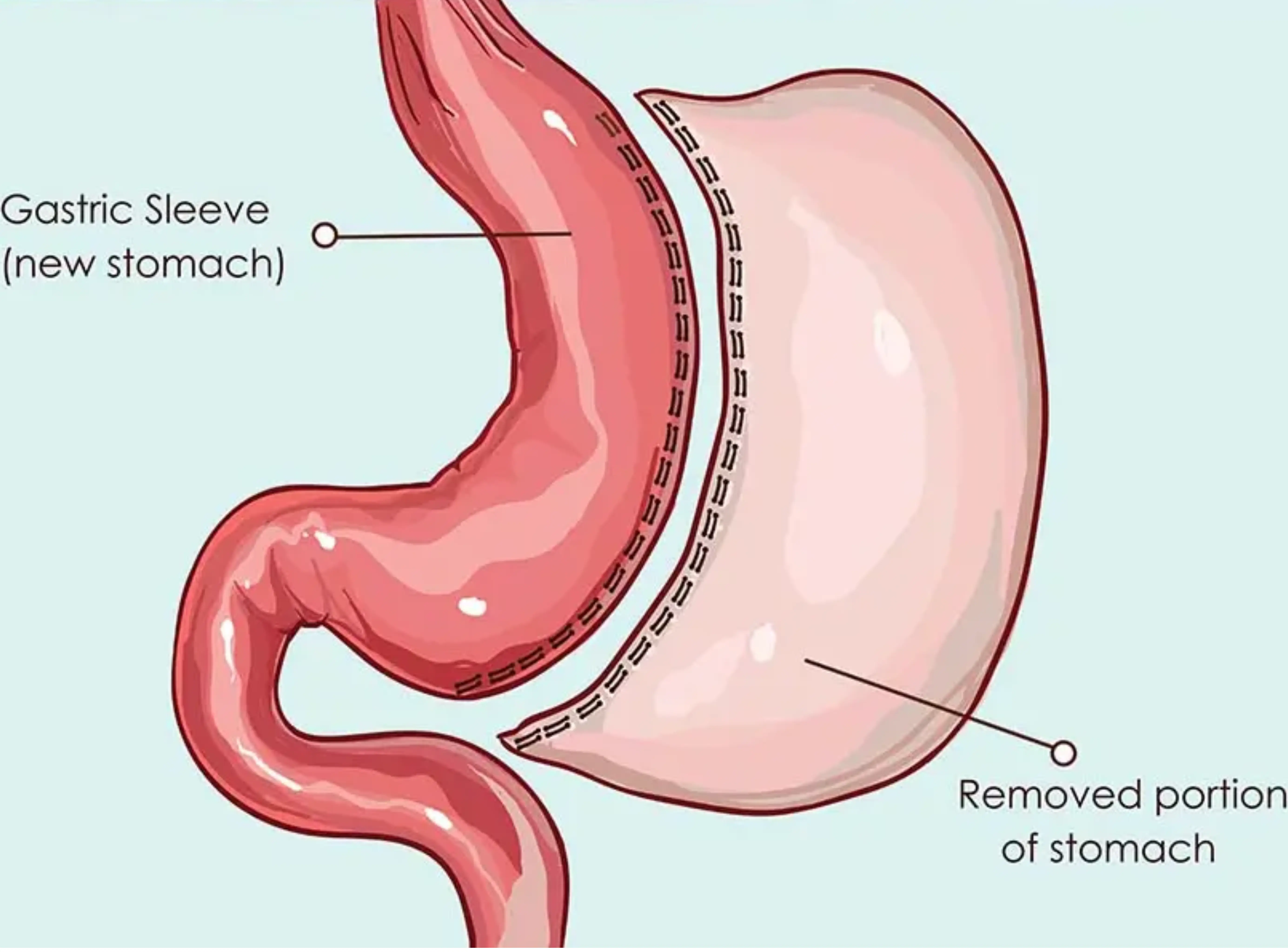 Sleeve Gastrectomy
